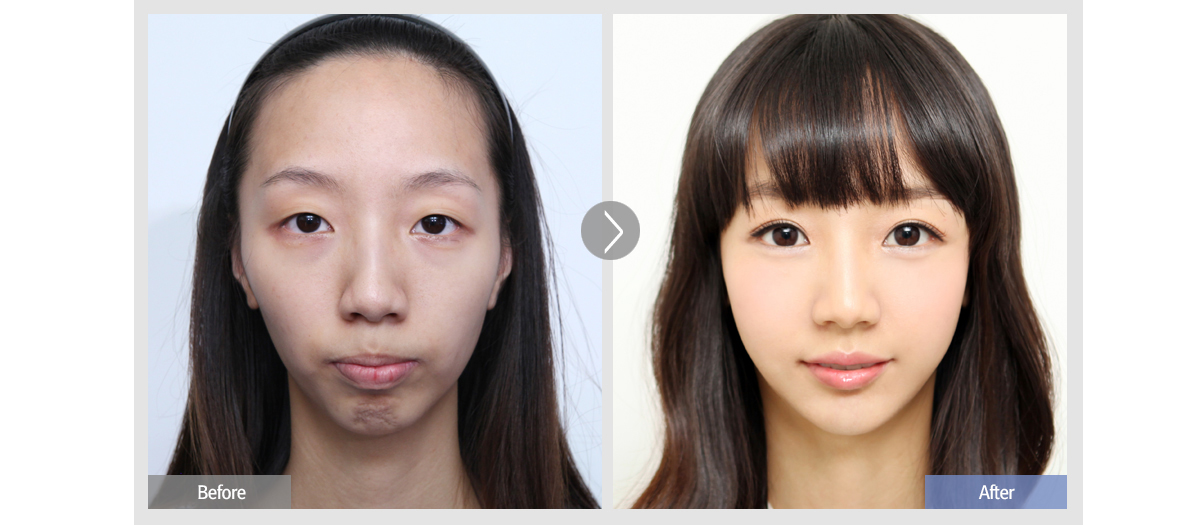 FACELINE的无下巴手术before&after style=