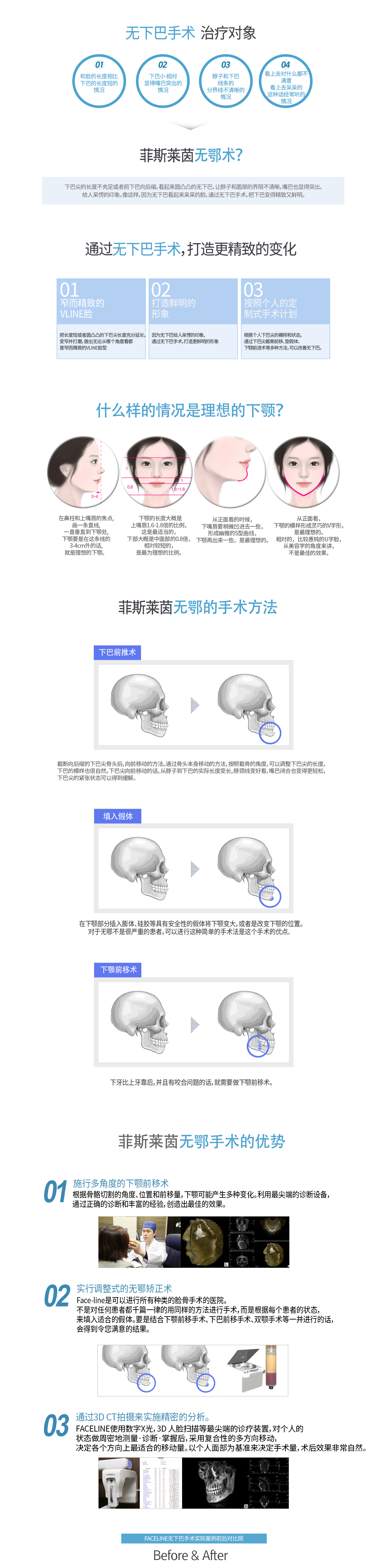 FACELINE的无下巴手术是指？